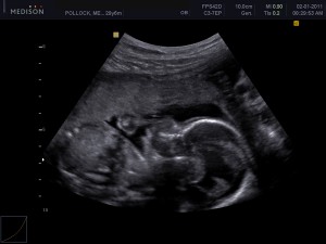 Ultrasound reveals Jordan's spina bifida