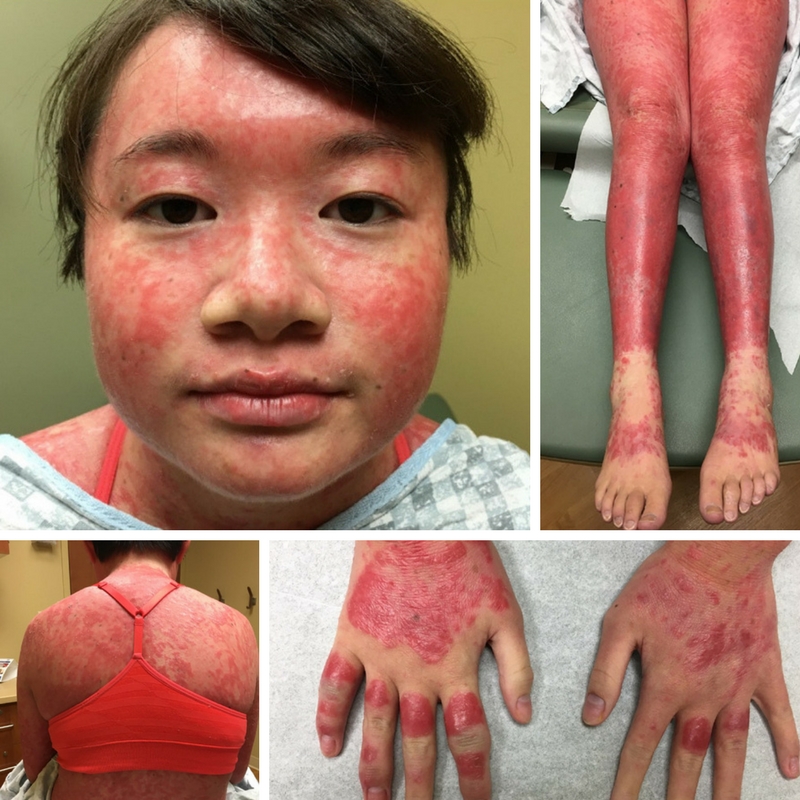 Psoriasis Therapy Gives Teen Her Life Back